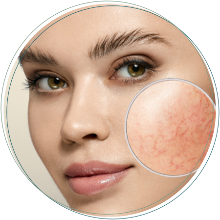 acne rosacea