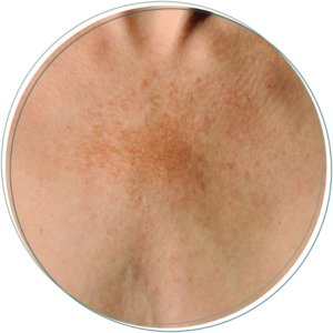 cancer melasma