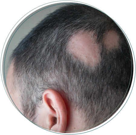 connective alopecia