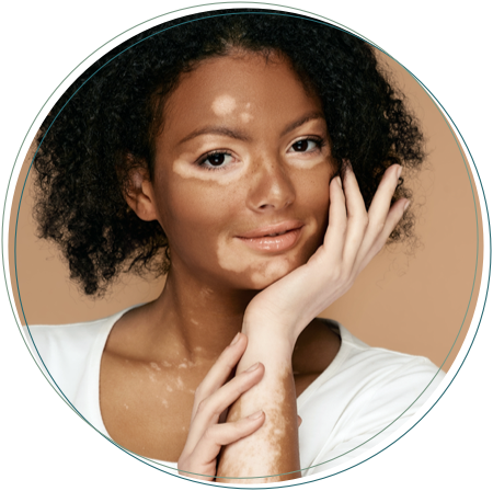 connective vitiligo