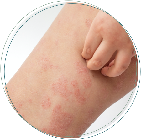 Eczema rash deals