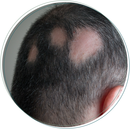 hair alopecia