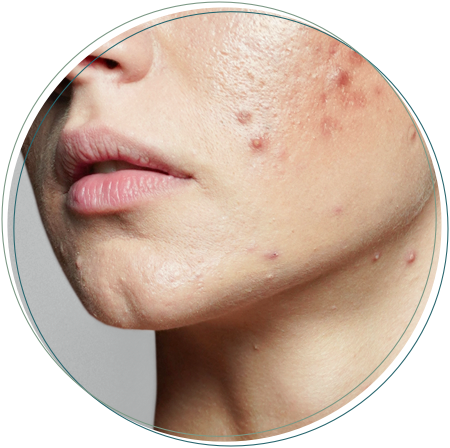 medical acne