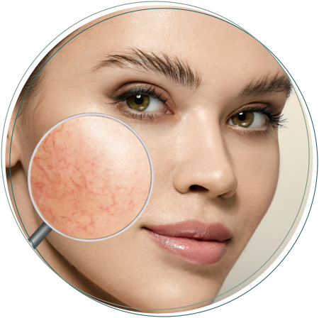 medical rosacea