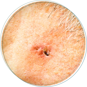 Basal Cell Carcinoma