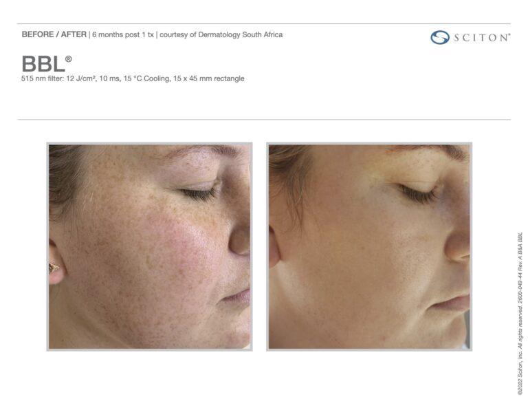 broadband light photofacial