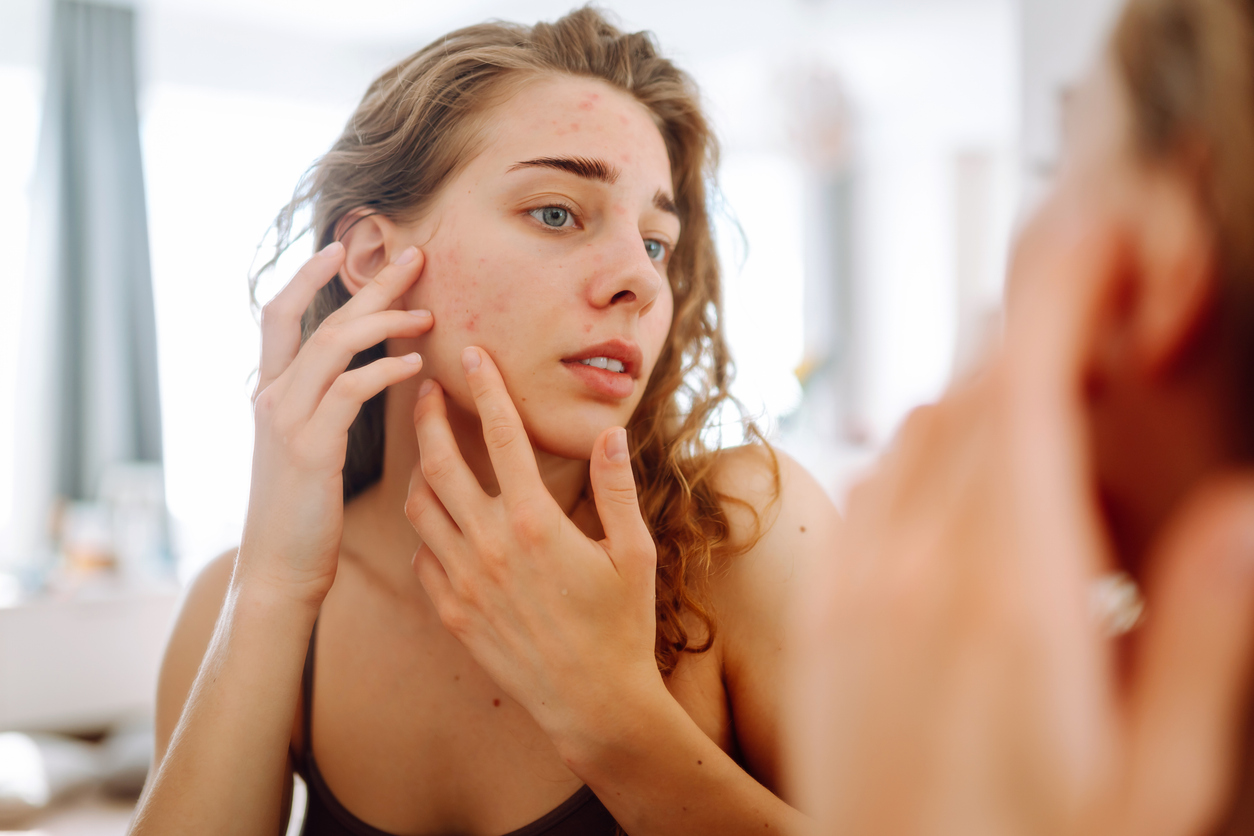 woman in mirror looking at her acne prone skin