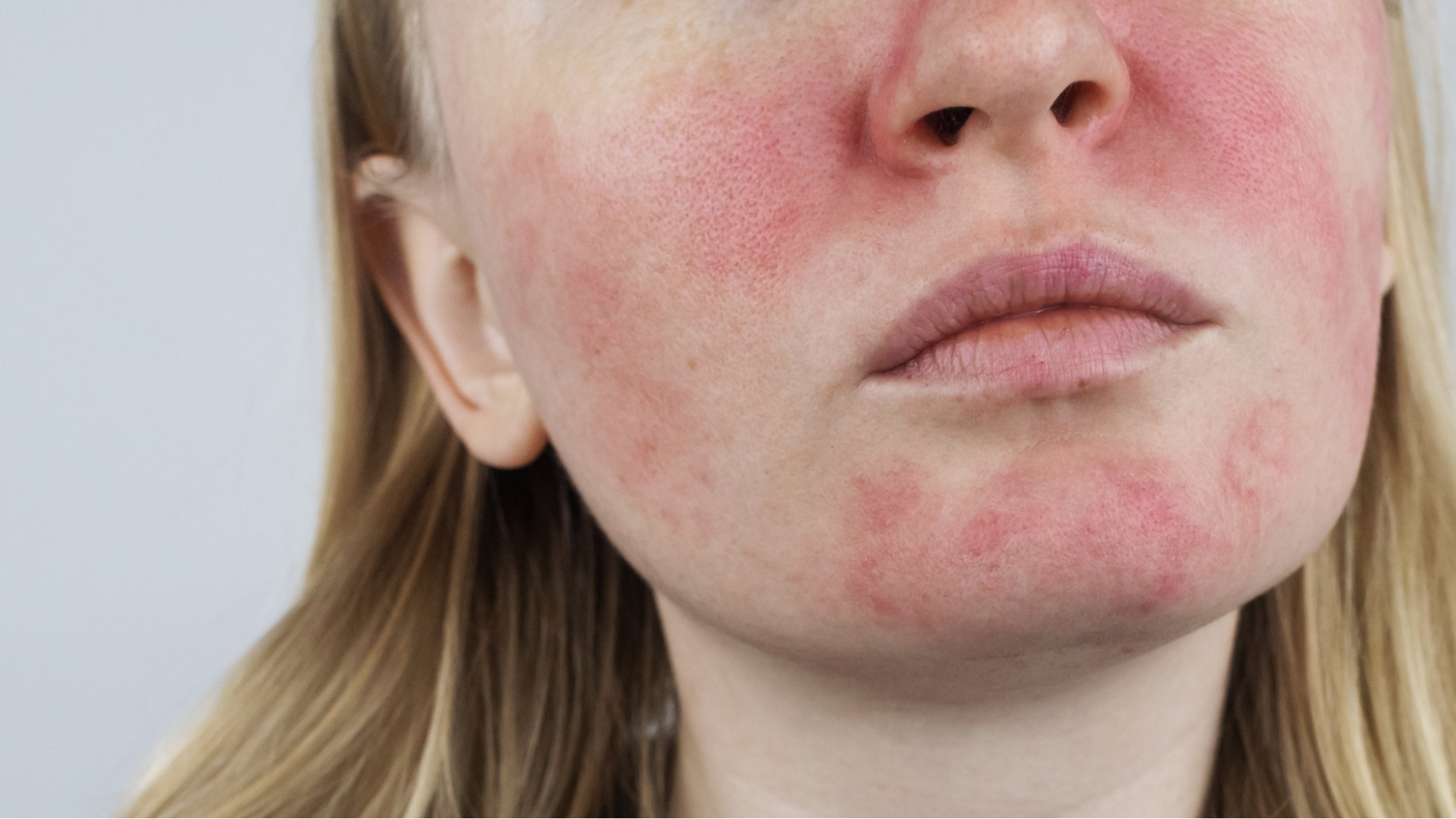 close-up-of-rosacea-flare-up-on-face