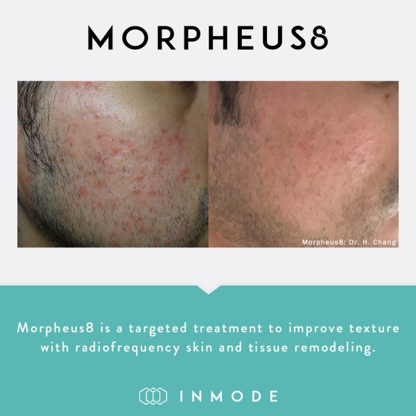 morpheus 8 before and after 3