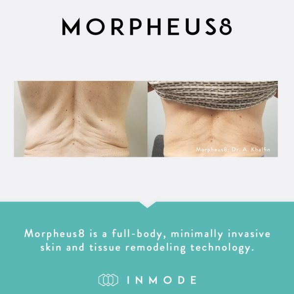 morpheus 8 before and after 4