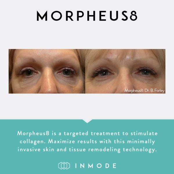 morpheus 8 before and after 2