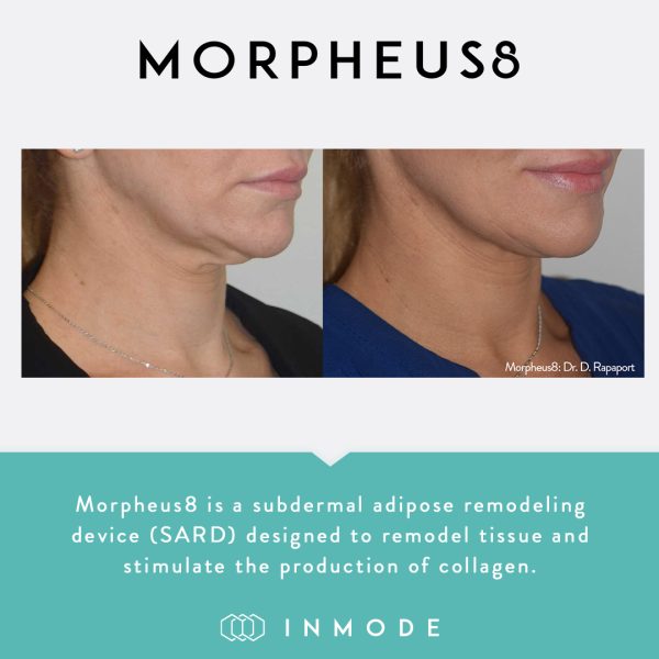 morpheus 8 before and after 1